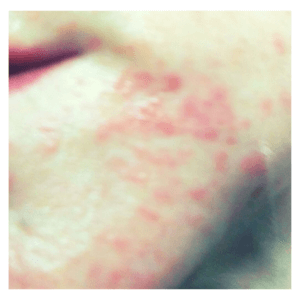 Skin rash caused by food reaction
